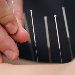 Acupuncture